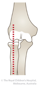 ED_Section 6_Box__RADIUS CAPITELLUM LINE_AP.jpg